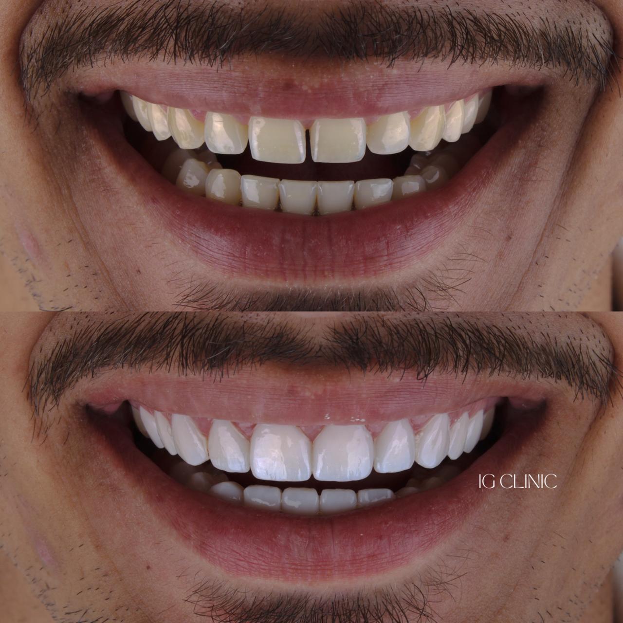 Resultado lentes de resina IG CLINIC - sorriso harmonioso e natural