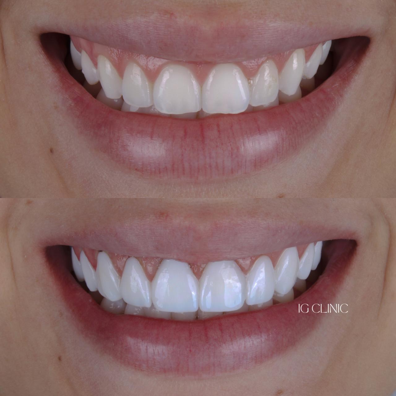 Paciente sorrindo após tratamento com lentes de resina na IG CLINIC - resultado natural e harmonioso