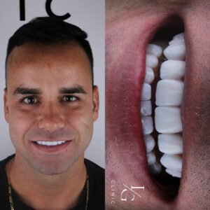 lentes-de-resina-sem-desgaste-do-dente-ig-clinic-clinica-dentista-especialista