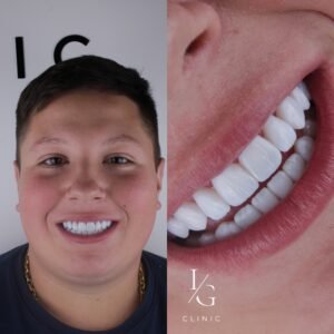 lentes-de-resina-sem-desgaste-do-dente-ig-clinic-clinica-dentista-especialista