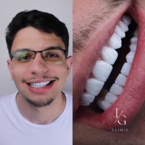 lentes-de-resina-sem-desgaste-do-dente-ig-clinic-clinica-dentista-especialista