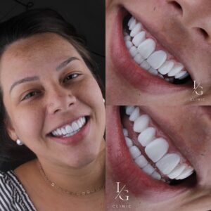 lentes-de-resina-sem-desgaste-do-dente-ig-clinic-clinica-dentista-especialista