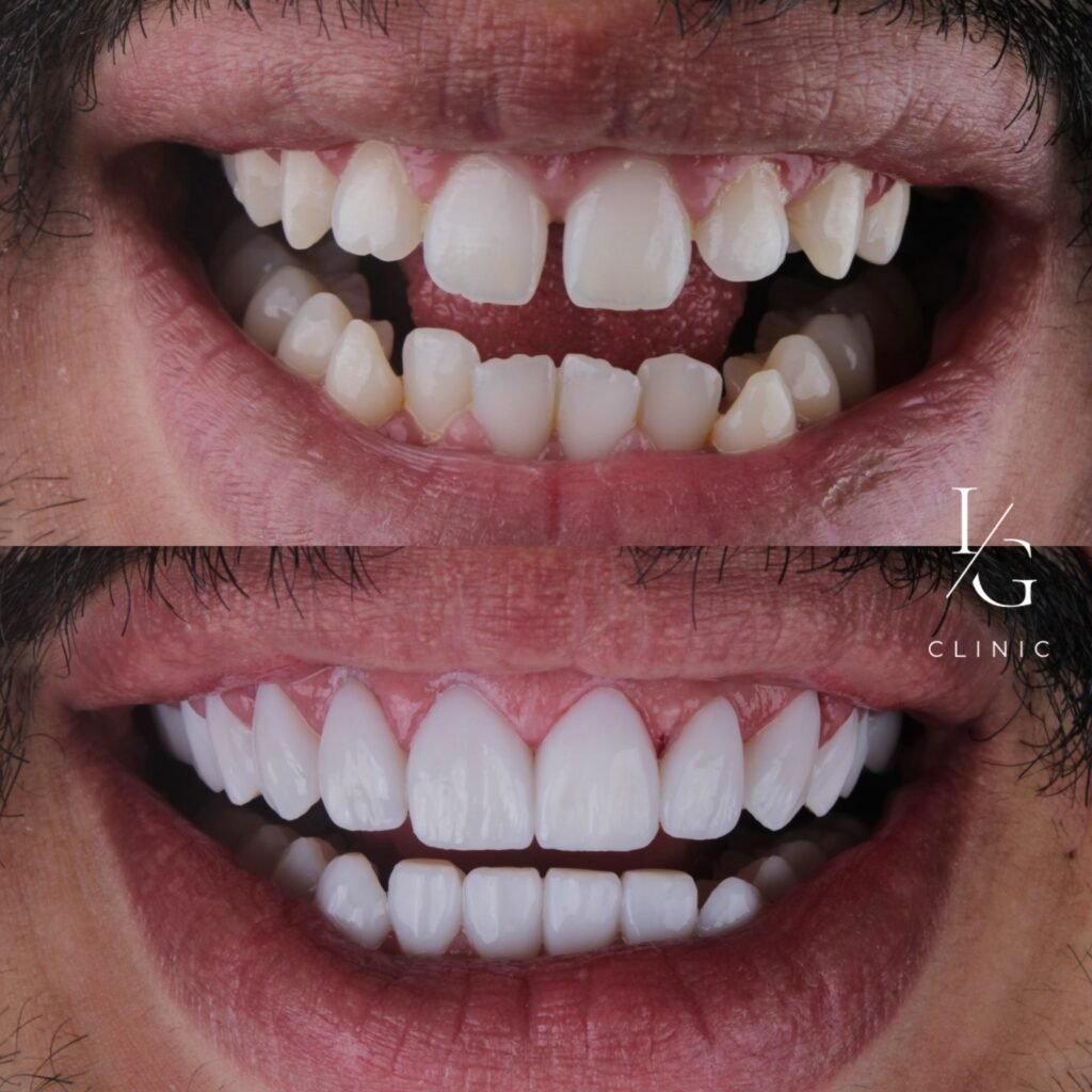 lentes-de-resina-sem-desgaste-do-dente-ig-clinic-clinica-dentista-especialista