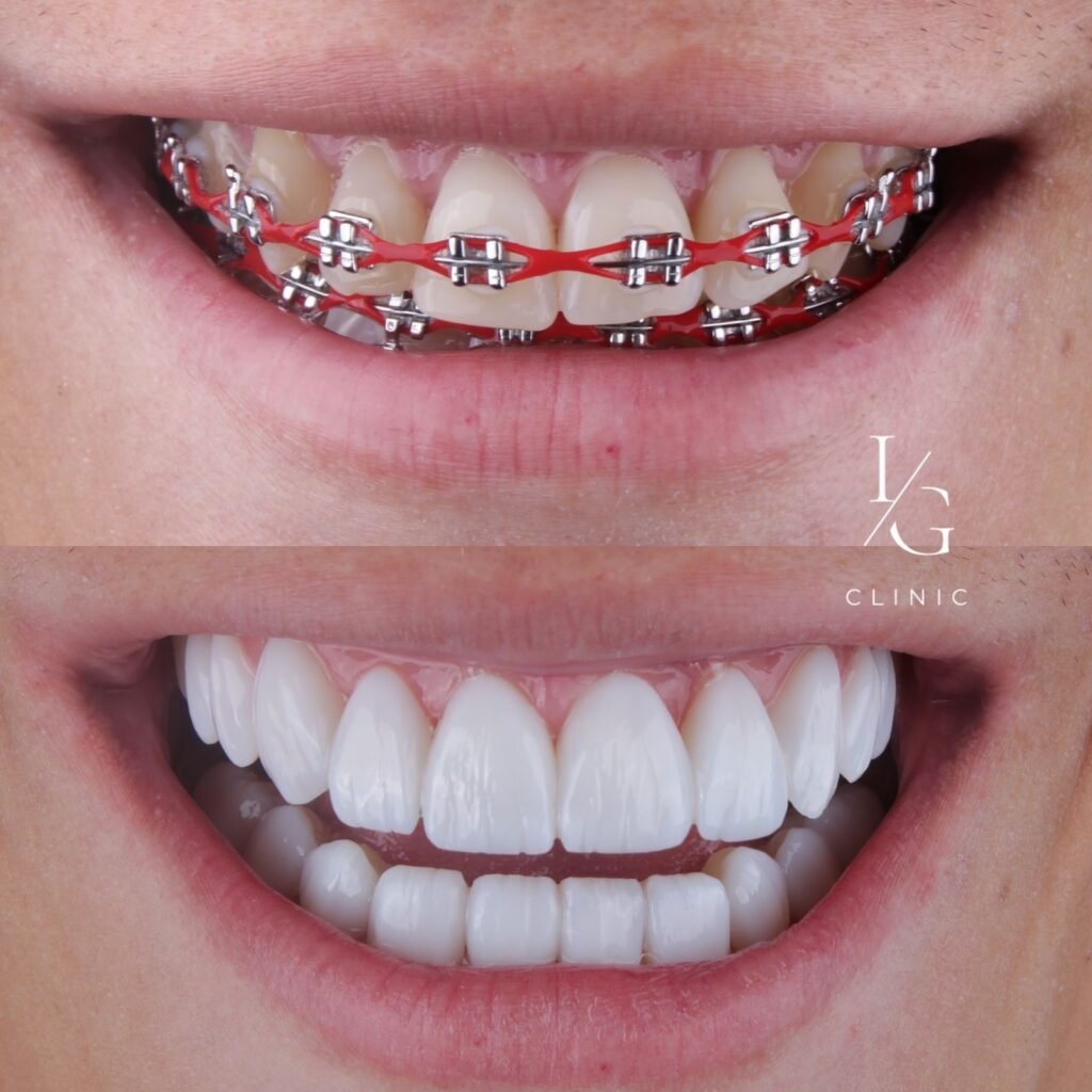 lentes-de-resina-sem-desgaste-do-dente-ig-clinic-clinica-dentista-especialista