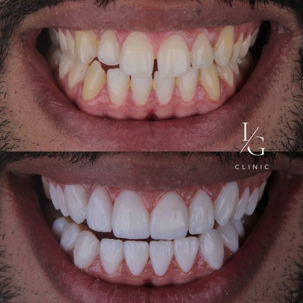 lentes-de-resina-sem-desgaste-do-dente-ig-clinic-clinica-dentista-especialista