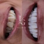 lentes-de-resina-sem-desgaste-do-dente-ig-clinic-clinica-dentista-especialista